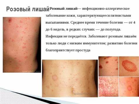 Лишай диета розовый жибера Лечение розового лишая жибера — Идеальная кожа Лечение розового лишая жибера — Идеальная кожа Лишай диета розовый жибера