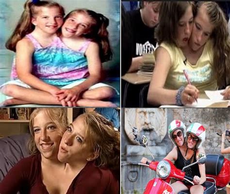 They are dicephalic parapagus twins, and are highly symmetric for conjoined twins, giving the appearance of having a single body without marked variation from normal proportions. Wedding Abby And Brittany Hensel