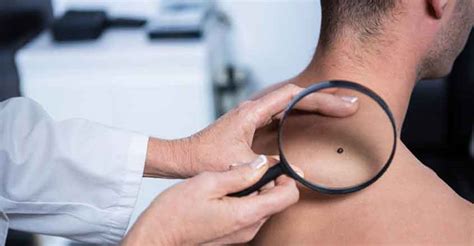 How to detect skin cancer? 'Virtual biopsy' device can detect skin tumours, non ...
