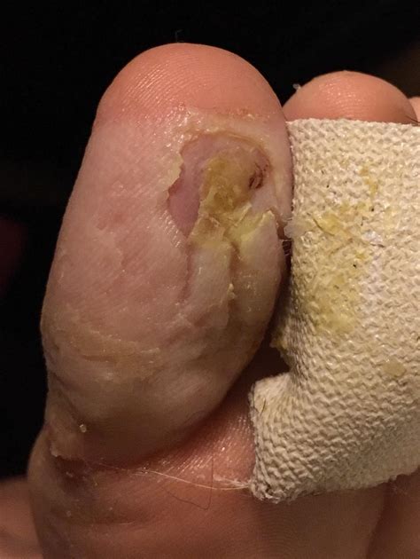 Care guide for plantar wart (aftercare instructions). maycintadamayantixibb: How To Use Beetlejuice For Warts