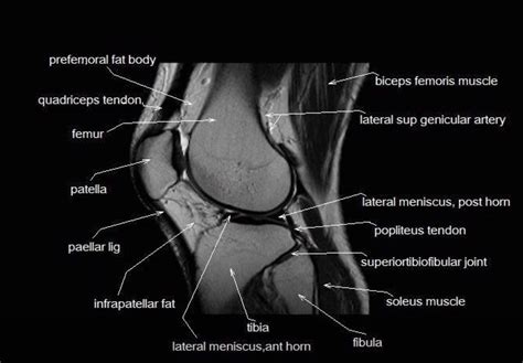 Learn anatomy using a full pacs! MRI anatomy of the knee | Ortopedia y traumatologia ...