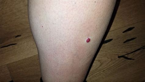 • the clinical presentation of cherry angiomas is usually diagnostic, although early lesions can resemble petechiae. Защо започнах да приемам йод като добавка, а съм с Хашимото | Фитнес инструктор