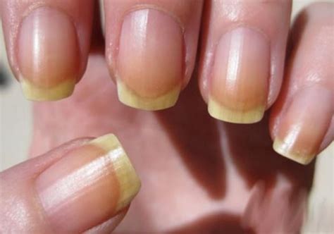 Les ongles peuvent servir à identifier une foule de problèmes de santé ...