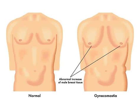 What sort of supplement benefits you? Elevated Prolactin Levels: How to Get Rid of Gynecomastia