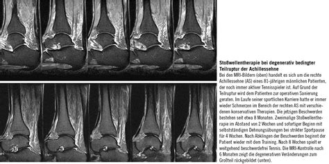 Kommt es aufgrund eines traumas oder einer andauernden beanspruchung zu einem kompletten oder inkompletten riss (ruptur) der achillessehne. Unfallchirurgie: Der Sehne Stabilität verleihen | klinik ...