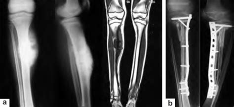 Children, adolescents, or young adults with ewing sarcoma may experience swelling and pain at the site where the tumor grows. Ewing´s Sarcoma — Causes and Radiology | Online Medical ...