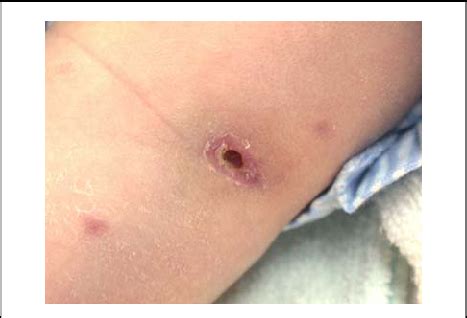 Unhealed BCG scar with discharge in the left deltoid area ...