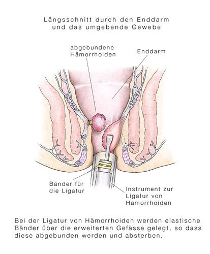 Kennst du alle macken deines partners? Hämorrhoiden-Operation, Entfernung von Hämorrhoiden ...