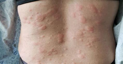 They may also burn or sting. Hives (Urticaria) | Semler