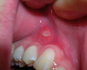 Once the abscess spreads to othe. Gum Injuries | Children's Dentistry of Longwood, P.A.