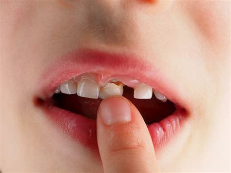 How to pull a loose tooth on a child. How To Deal With Loose Teeth - Real Smile Dental