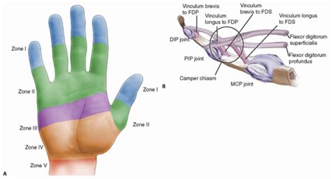 Injuries to the flexor tendons of the hand can be particularly challenging. Staged Digital Flexor Tendon Reconstruction ...