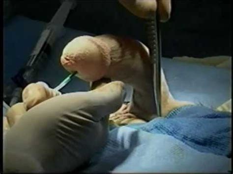07:04that is definitely an blow job session with babe. Surgical Technique for Repair of Peyronie's Disease - YouTube