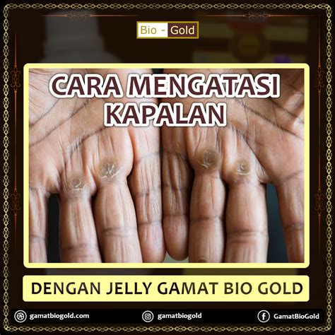 Cara Mengatasi Kapalan Dengan Jelly Gamat Bio Gold
