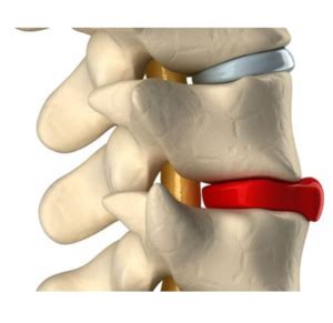 Nerve root pain (usually sciatica). What is a Bulging Disc? Symptoms & treatment | Spine Laser ...