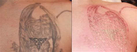 Have you evolved as a person and a tattoo that used to represent you no longer does? Laser Tattoo Removal: Rethinking An Inking? - New York ...