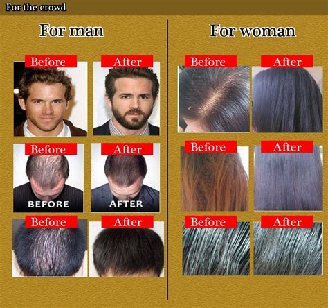 You may need to take it for several months or years. Booklet: Best Medicine For Hair Loss And Regrowth