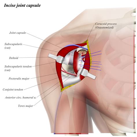 Thickening or calcium deposits in the supraspinatus tendon or subacromial bursitis results in pain during abduction of shoulder joint from. Shoulder Anterior (Deltopectoral) Approach - Approaches ...