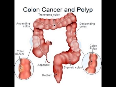Only do this if you really mean it because they will definitely fall in love with you. Colon Cancer - YouTube