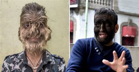 Medically speaking, hirsutism is actually a type of hypertrichosis that mostly occurs in women and children but. Children in Spain develop 'werewolf syndrome' after taking ...