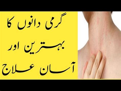 Dano ka ilaj, remove dark spots on face, acne ka ilaj in urdu/hindi. Garmi Dano ka Fori ilaj at Home (2019) | Face Pr Grmi Dano ...