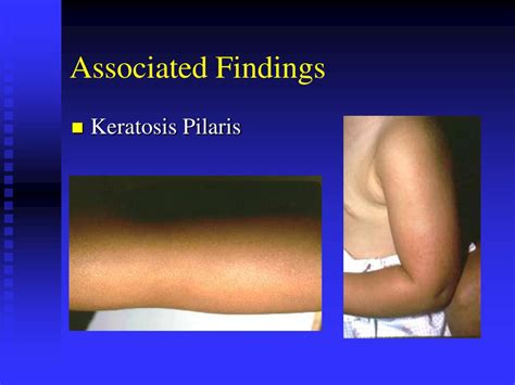 Pityriasis alba is a common skin complaint of children and young adults. PPT - Atopic Dermatitis PowerPoint Presentation, free ...