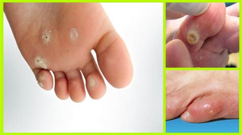 Callus pads, consisting of felt, silicone, and a gentle adhesive, can be applied to the. Corn Removal - How to Treat Corn on Foot - Corn Treatment ...