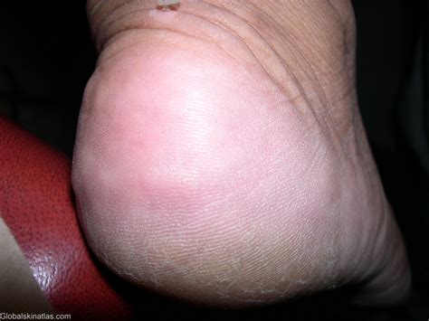 Jul 29, 2021 · piezogenic pedal papules are small fatty herniations through fascial defects of the heels. Global Skin Atlas - Diagnosis Detail