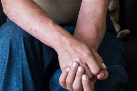 Researchers say they have identified eight different they received 3,195 pictures in total, which were reviewed, classified and curated by a team of senior dermatologists. Possible Connection Between Skin Rashes and COVID-19 ...