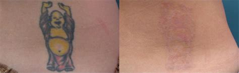 What is laser tattoo removal? enlighten™ III by CUTERA® Laser Tattoo Removal Treatment in Midtown Toronto | Midtown Med Spa ...