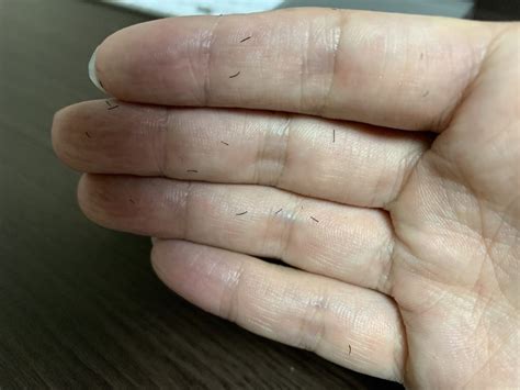 ヒゲ3回目の照射 | 経験知