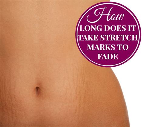 Here, a dermatologist and a plastic surgeon break down the best ways to treat can you actually get rid of stretch marks? How Long Does it Take Stretch Marks to Fade | An article ...