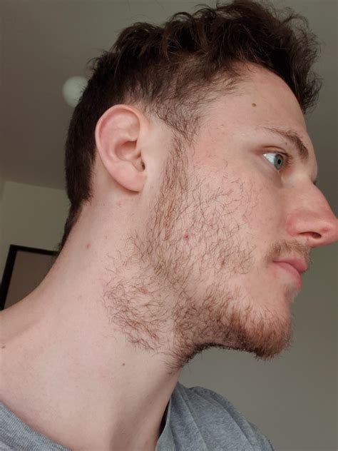 Females with cushing syndrome often grow excess facial hair and have irregular periods. Need advice - is this facial hair density enough for ...