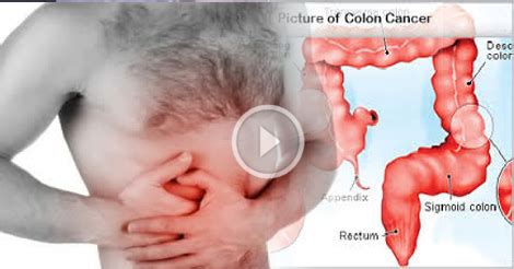 For this test, a small wand is moved around on your skin. Colon Cancer: Do You Know You Can Have It? Facts & Info ...