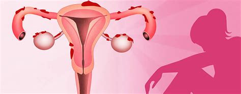 Learn more about the types, symptoms, causes, diagnosis, stages, treatment, and. Endometriosis: Síntomas, causas prevención - Medstetic Panamá