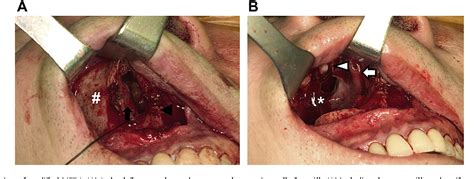 Midfacial degloving is an extended sublabial rhinotomy. A modified midfacial degloving approach for the treatment ...