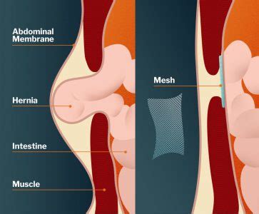 Many factors cause mesh migration, which may or may not be associated to infection. What is Hernia Mesh: Surgery, Complications, Problems, Lawsuit, Settlements