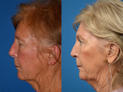 He specializes in face and nose procedures. Brow Lift Photos | Melbourne, FL | Patient 55025