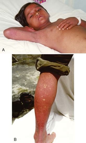 A unique hantavirus has been identified as the cause of the outbreak of respiratory illness (hantavirus pulmonary syndrome) first recognized in the four corners region sw usa in 1993. Dengue | Anesthesia Key