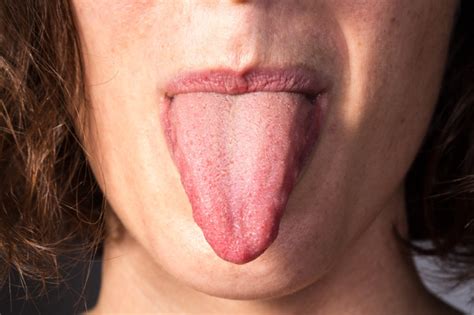 Burning Tongue: 9 Causes, One Life-Threatening » Scary Symptoms