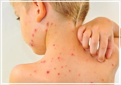 Chickenpox is a normal disease which is caused by the infection due to a virus called varicella zoster. Terkena Jangkitan 'Chicken Pox', Ini Makanan Yang Boleh ...