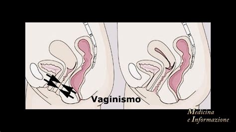 Puede tomar semanas a meses lograr que haya un poco de alivio del dolor. Vaginismo e Vulvodinia: sintomi e cause dolore pelvico ...