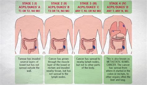 These options are generally reserved for people with a high risk of colon cancer. Colon Cancer Symptoms - Colorectal (Bowel) Cancer ...