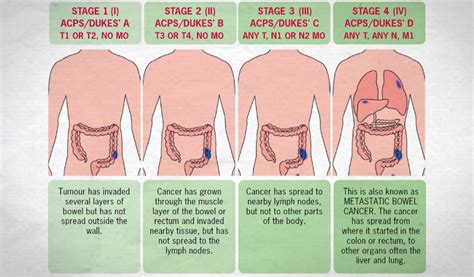 Read about the symptoms of bowel cancer. Colon Cancer Symptoms - Colorectal (Bowel) Cancer ...