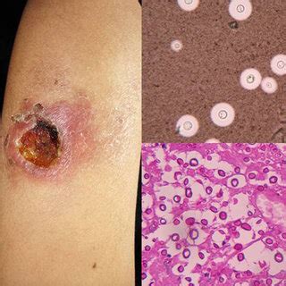 Zigomicosis (mucormicosis) cutánea en paciente con leucemia. Mucormicosis rinocerebral-cutánea en paciente diabético ...