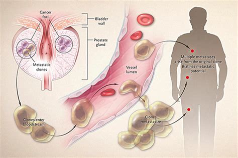 Stage 4 prostate cancer may be categorized as a local metastasis or a distant metastasis. Metastatic Prostate Cancer: What You Need To Know - Health ...