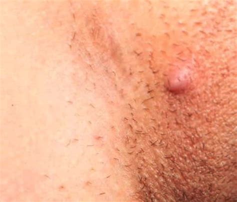 Removing ingrown facial hair naturally at home 6. Keep Getting Ingrown Hairs On Face | Ingrown Hair