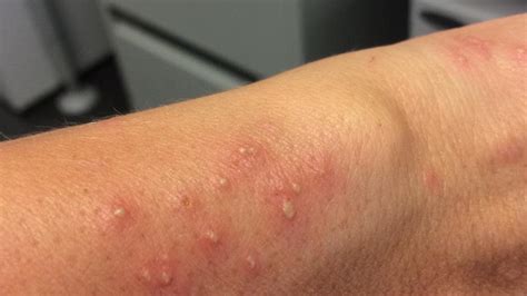 Ant bites can be painful for a few seconds but what is worse is the desire to itch the bite area. Qld Government fire ant inspectors take three months to ...