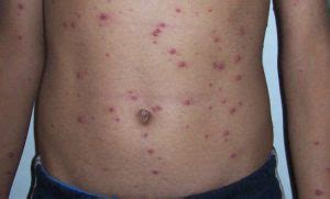 Symptoms of chicken pox (varicella). Home Remedies for Chicken Pox - Symptoms of Chicken Pox