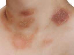 Do not scratch the heat rash, as this may lead to infection. Pityriasis rosea: Symptoms, diagnosis, and treatment